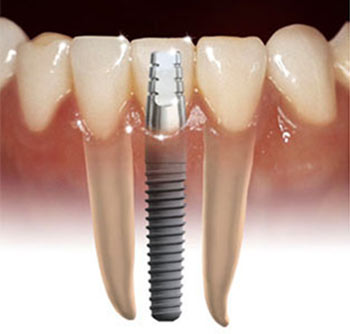 A Lack of Dental Implants Can Cause More than a Broken Smile